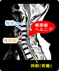 頸椎椎間板ヘルニア